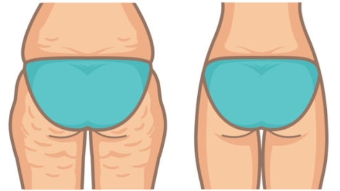 cellimine piel de naranja